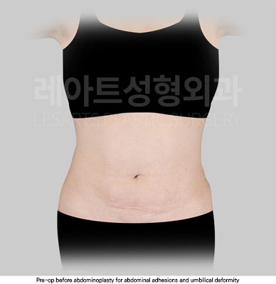 tummy-tuck-02-01-251030