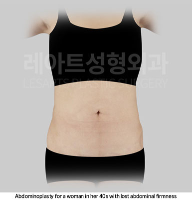 tummy-tuck-02-01-251105
