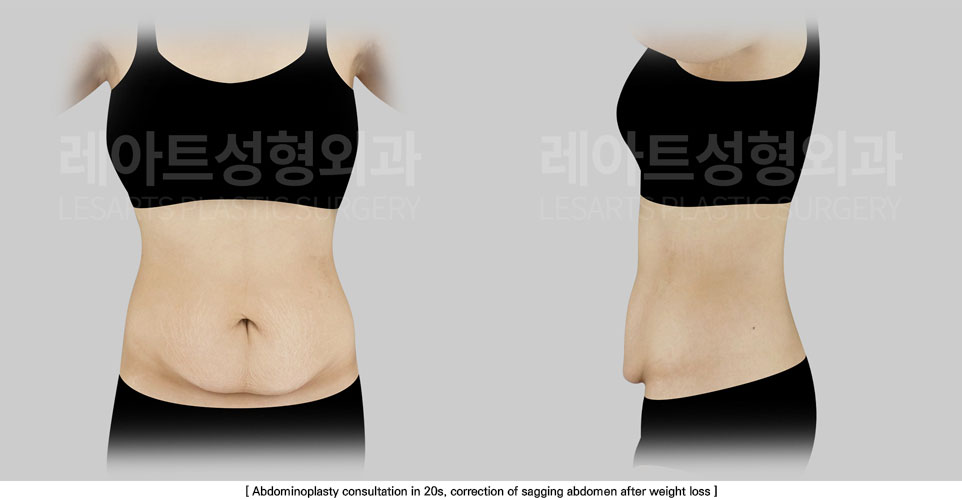 tummy-tuck-02-01-251111