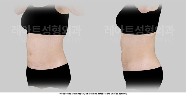 tummy-tuck-02-02-251030