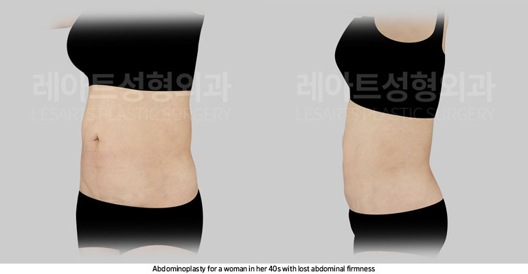 tummy-tuck-02-02-251105