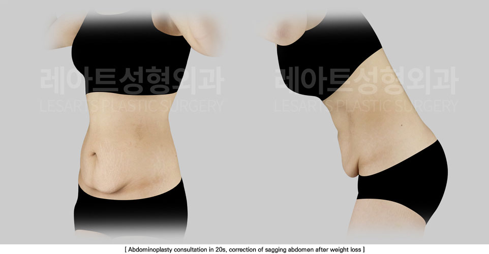 tummy-tuck-02-02-251111