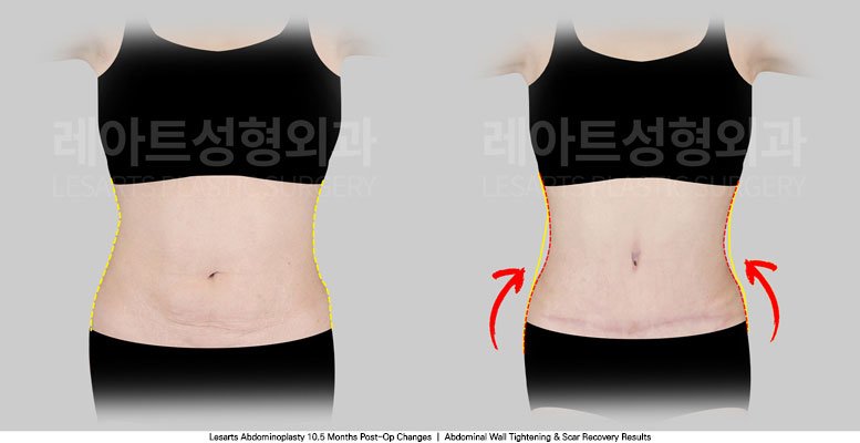 tummy-tuck-02-03-251030
