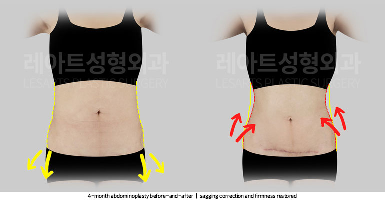 tummy-tuck-02-03-251105