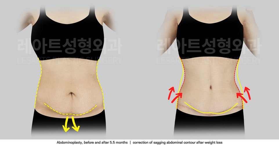 tummy-tuck-02-03-251111