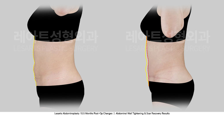 tummy-tuck-02-04-251030