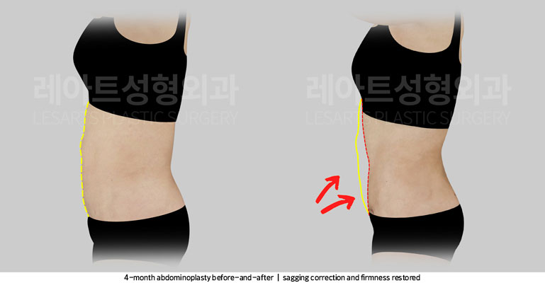 tummy-tuck-02-04-251105