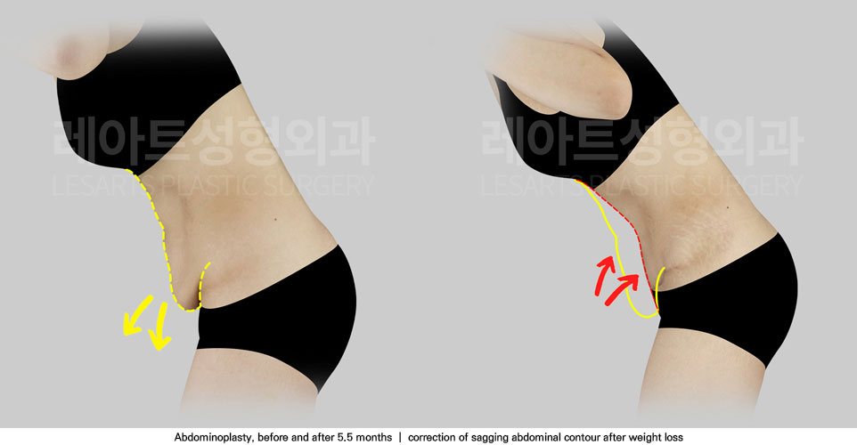 tummy-tuck-02-04-251111