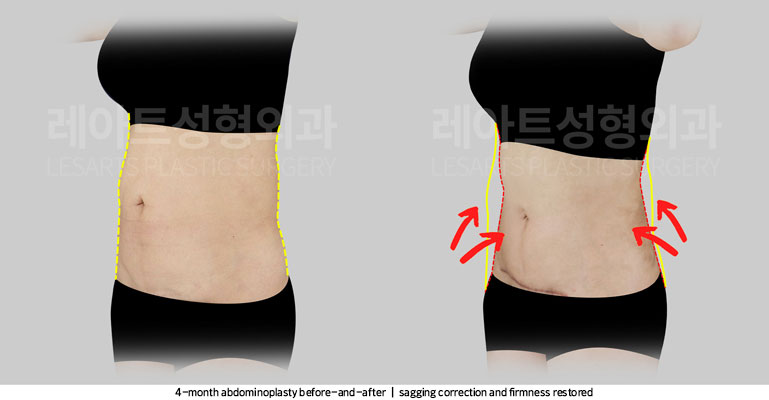 tummy-tuck-02-05-251105