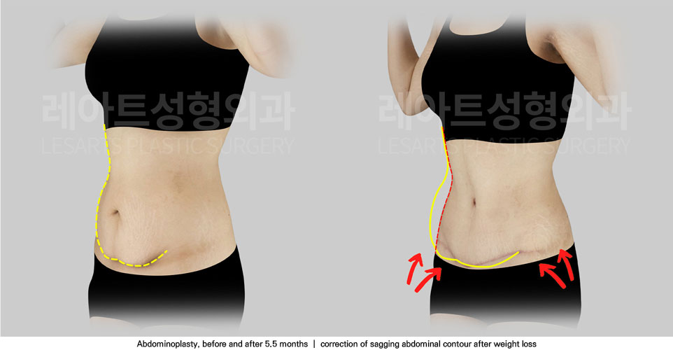 tummy-tuck-02-05-251111