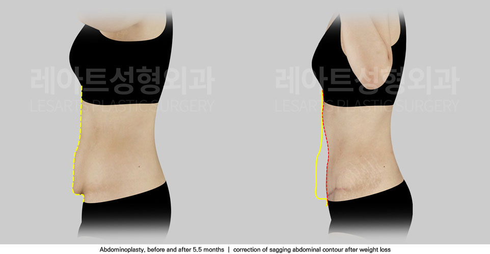 tummy-tuck-02-06-251111