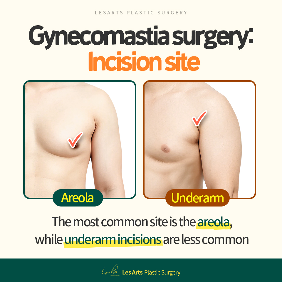 [Gynecomastia] Benefits and considerations of areolar incision in gynecomastia surgery