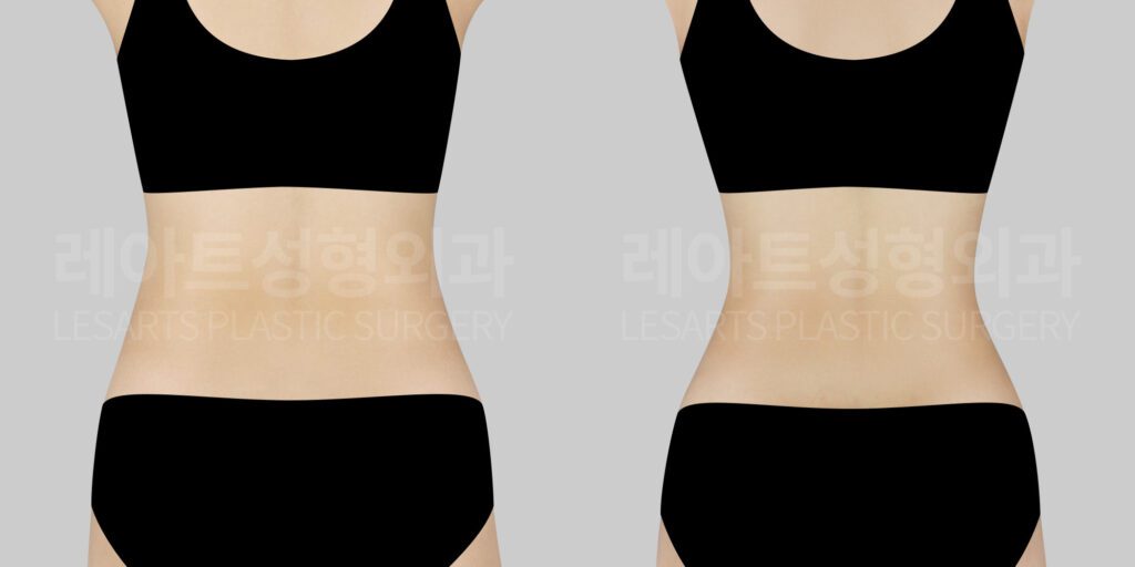abdominal liposuction before and after