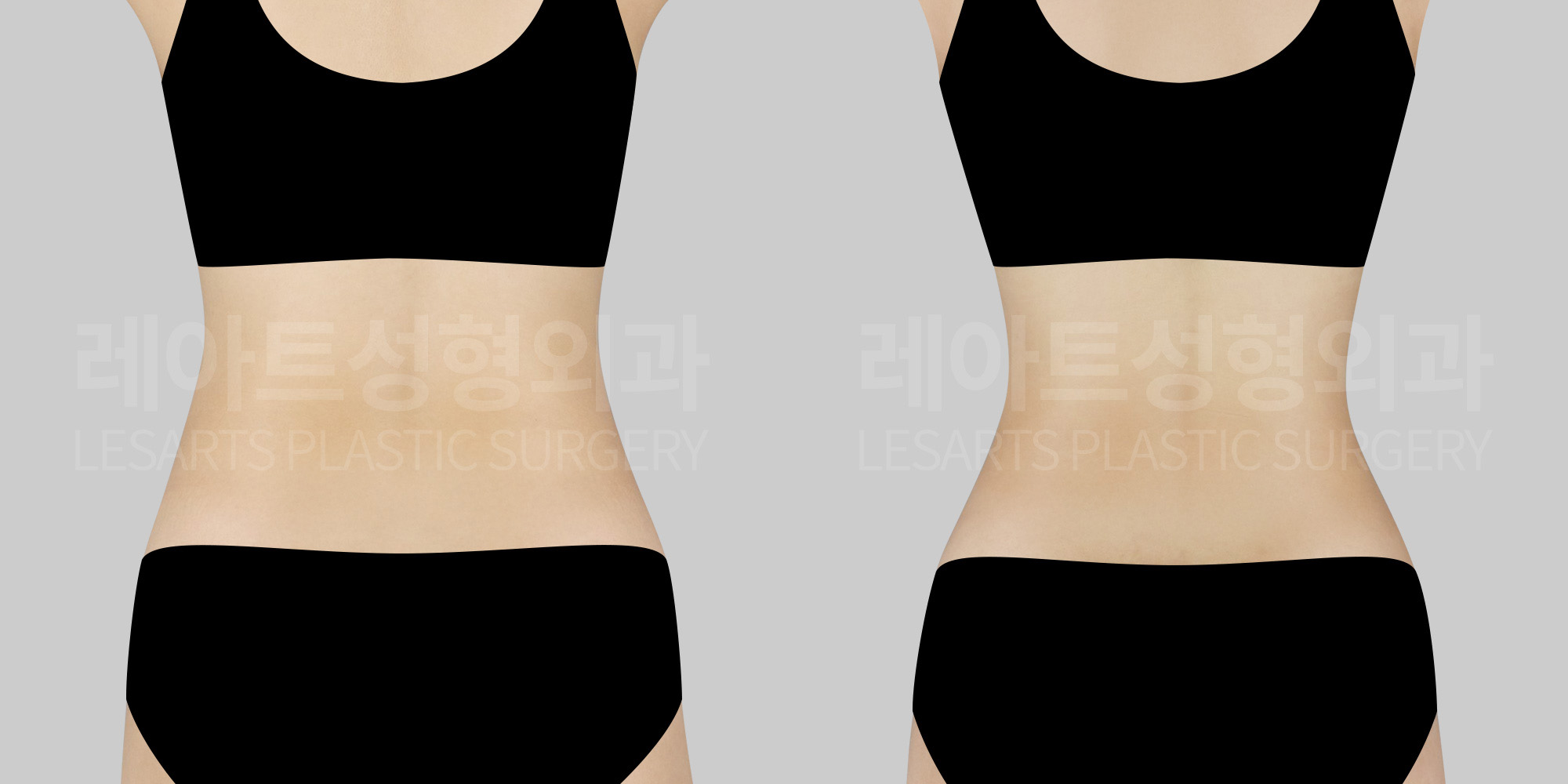 abdominal liposuction before and after