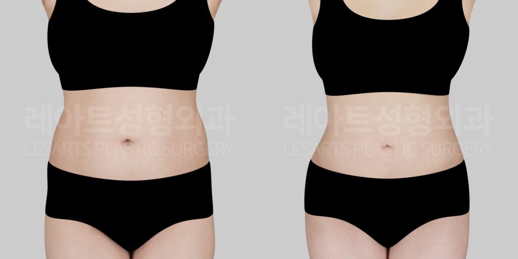 lesarts abdominal liposuction before and after