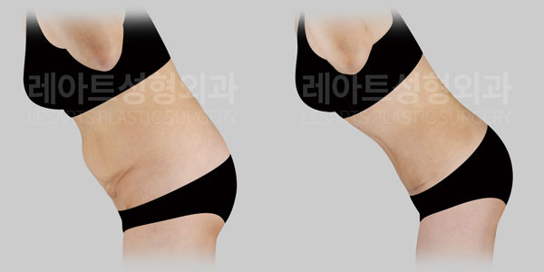 lesarts abdominoplasty before and after