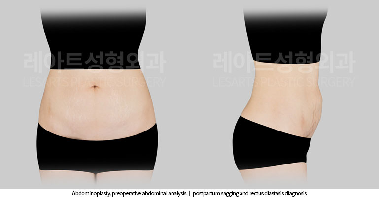 abdominoplasty-02-01-251117