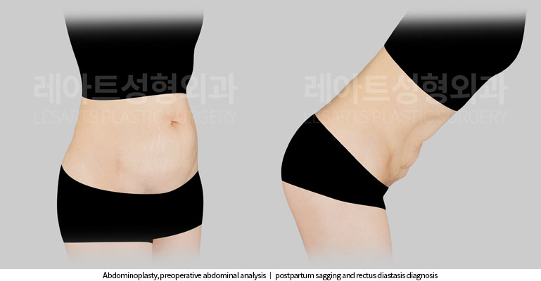 abdominoplasty-02-02-251117