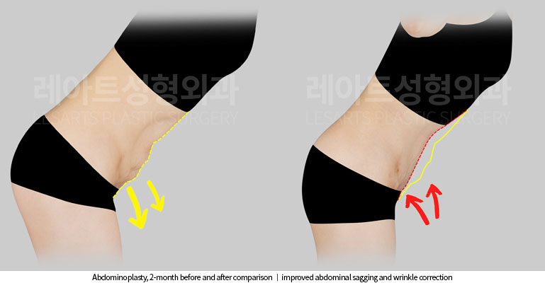 abdominoplasty-02-06-251117