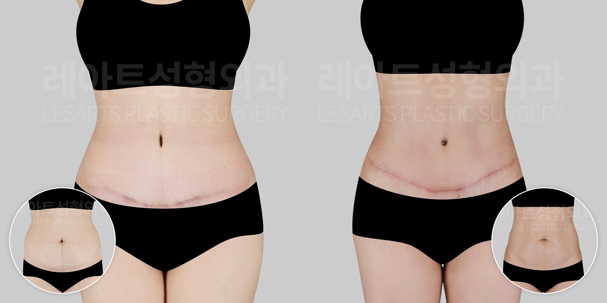 [Abdominoplasty] What Determines the Scar Position in Abdominoplasty?