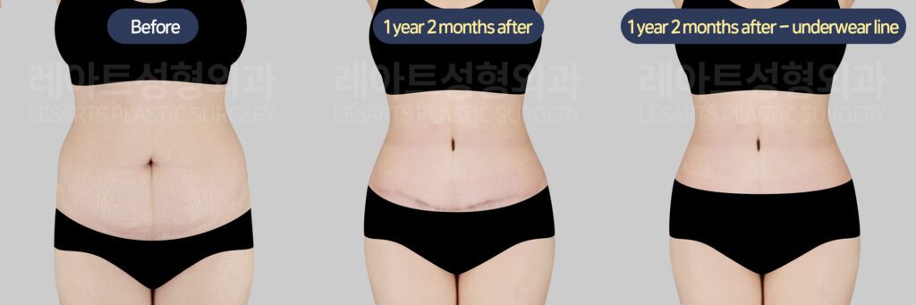 abdominoplasty before and after