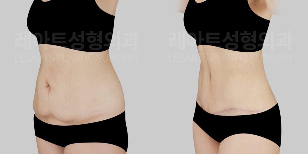 lesarts abdominoplasty before and after