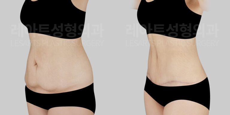 lesarts abdominoplasty before and after