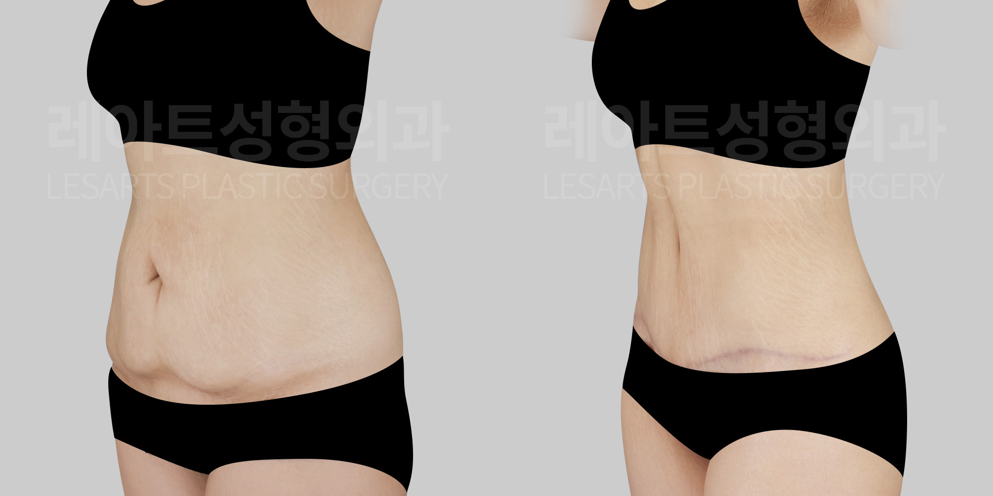 lesarts abdominoplasty before and after
