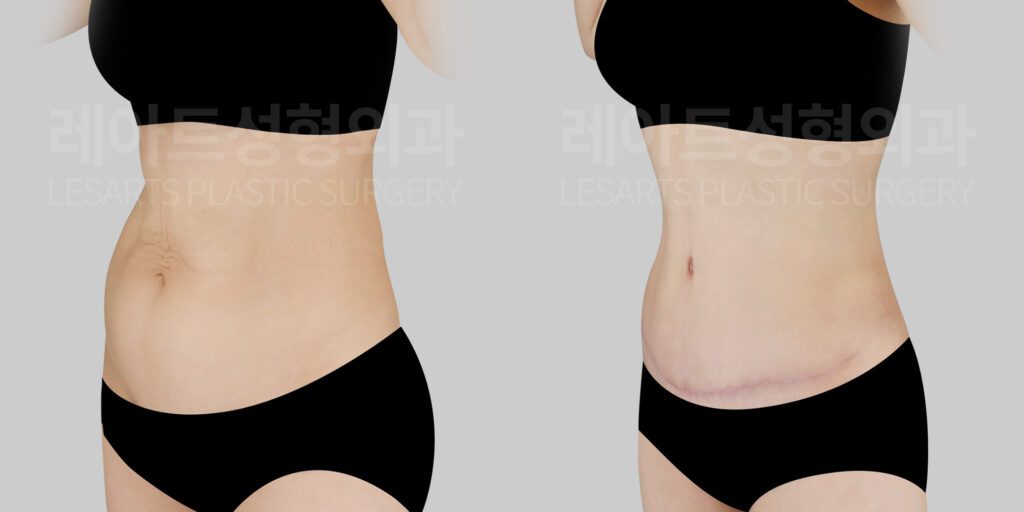 lesarts abdominoplasty before and after