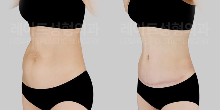 lesarts abdominoplasty before and after