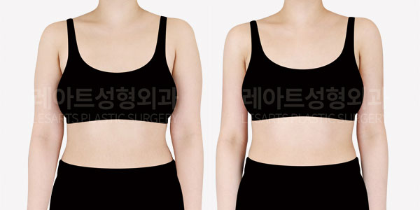 arm liposuction before and after - lesarts