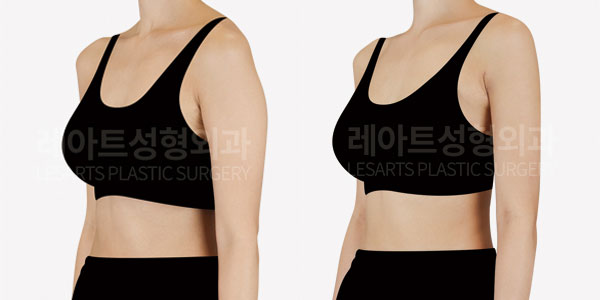 arm liposuction before and after - lesarts plastic surgery