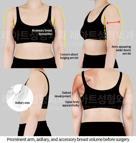 arm-liposuction-02-01-251120