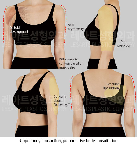 arm-liposuction-02-01-251124