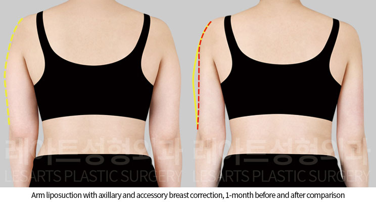 arm-liposuction-02-03-251120