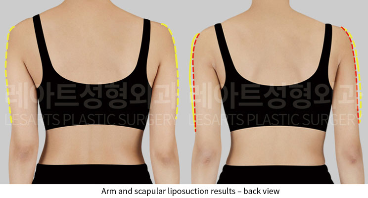 arm-liposuction-02-03-251124