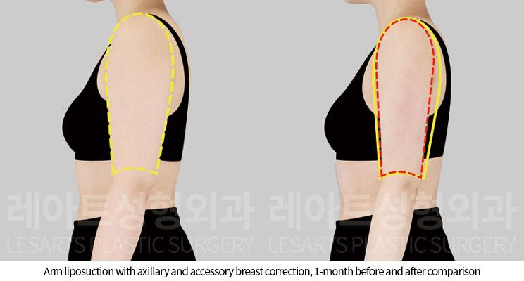arm-liposuction-02-04-251120