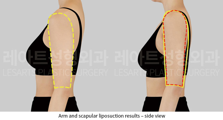 arm-liposuction-02-04-251124