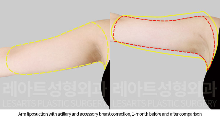 arm-liposuction-02-05-251120