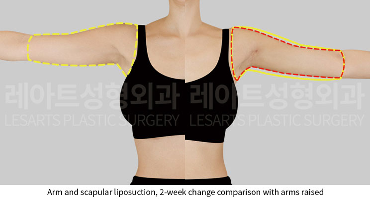 arm-liposuction-02-05-251124