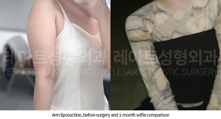 arm-liposuction-02-06-251120