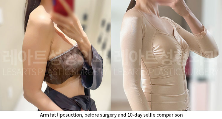 arm-liposuction-02-06-251124