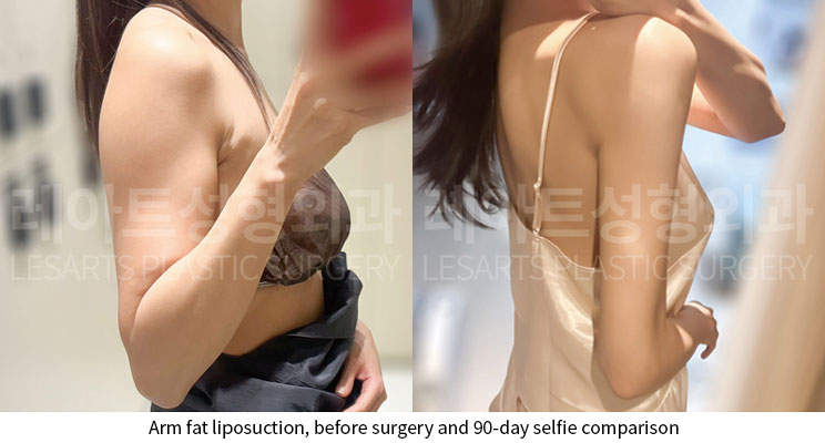 arm-liposuction-02-07-251124