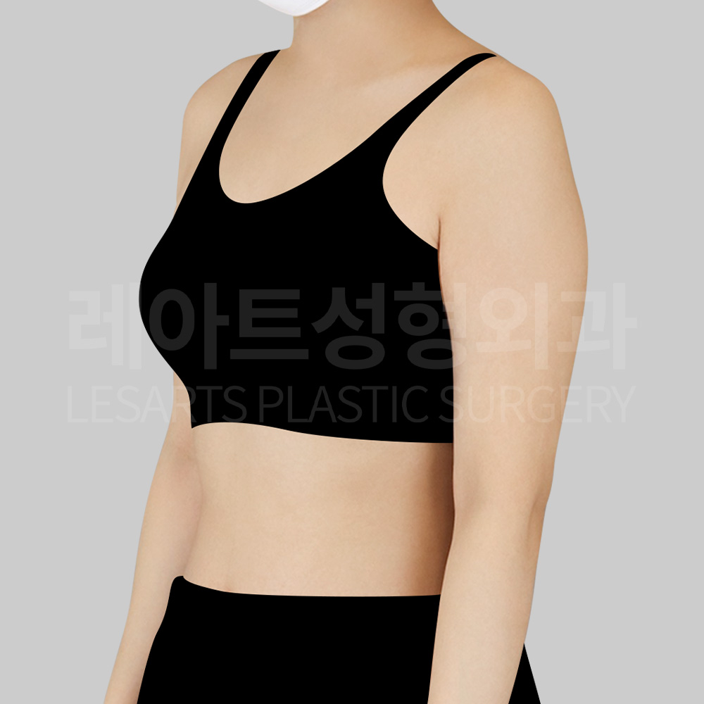 arm-liposuction-23613-before-45degree