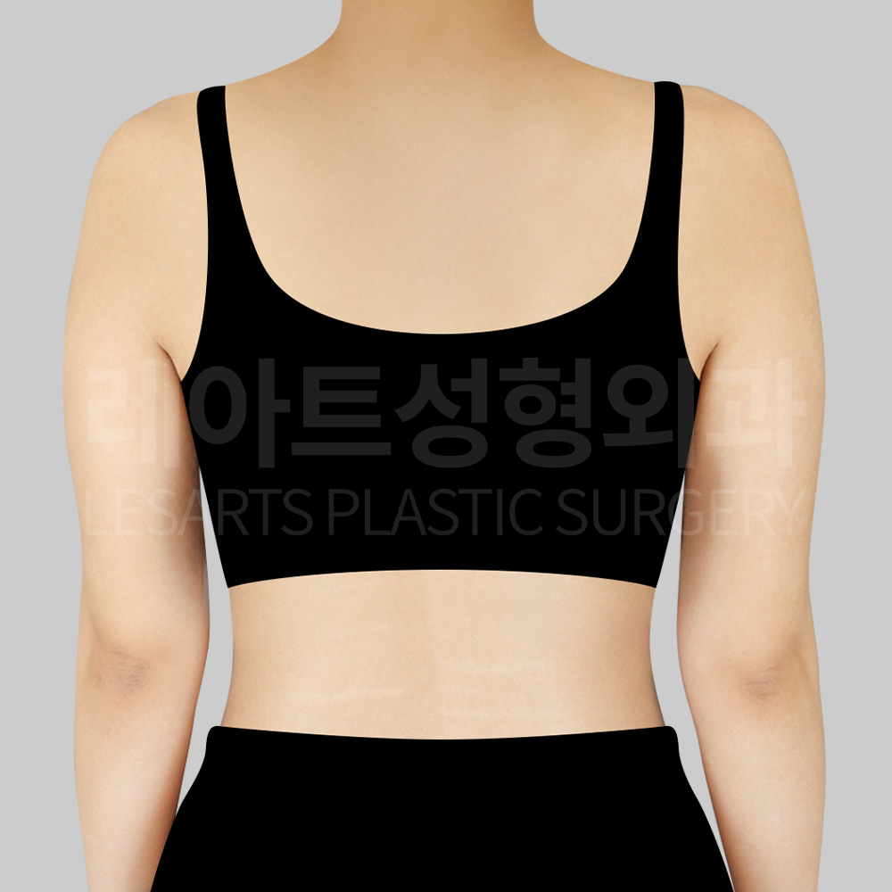 arm-liposuction-23613-before-back