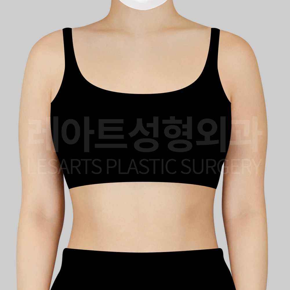 arm-liposuction-23613-before-front