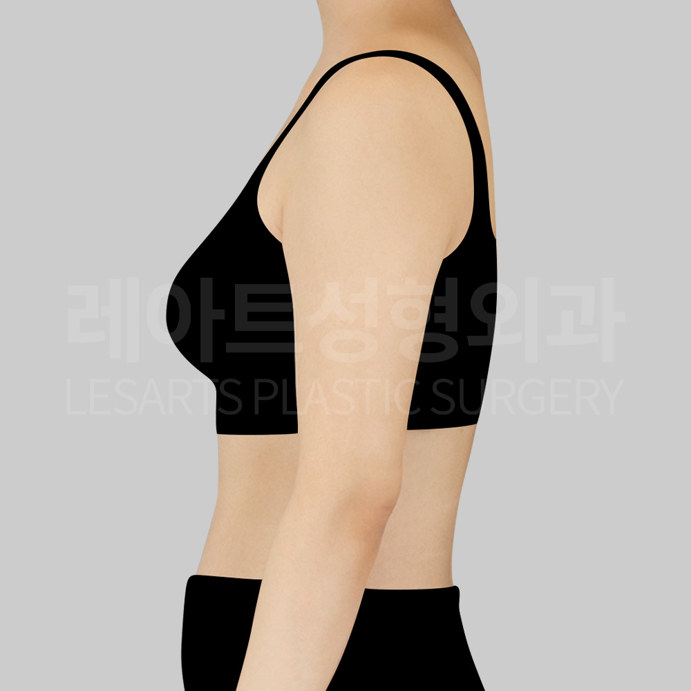 arm-liposuction-23613-before-side