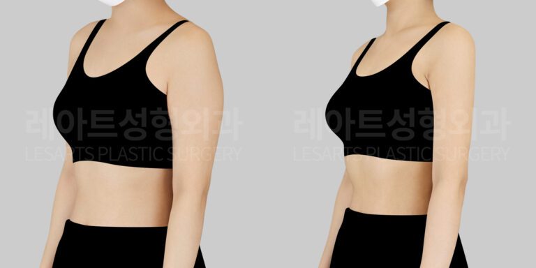 arm liposuction before and after