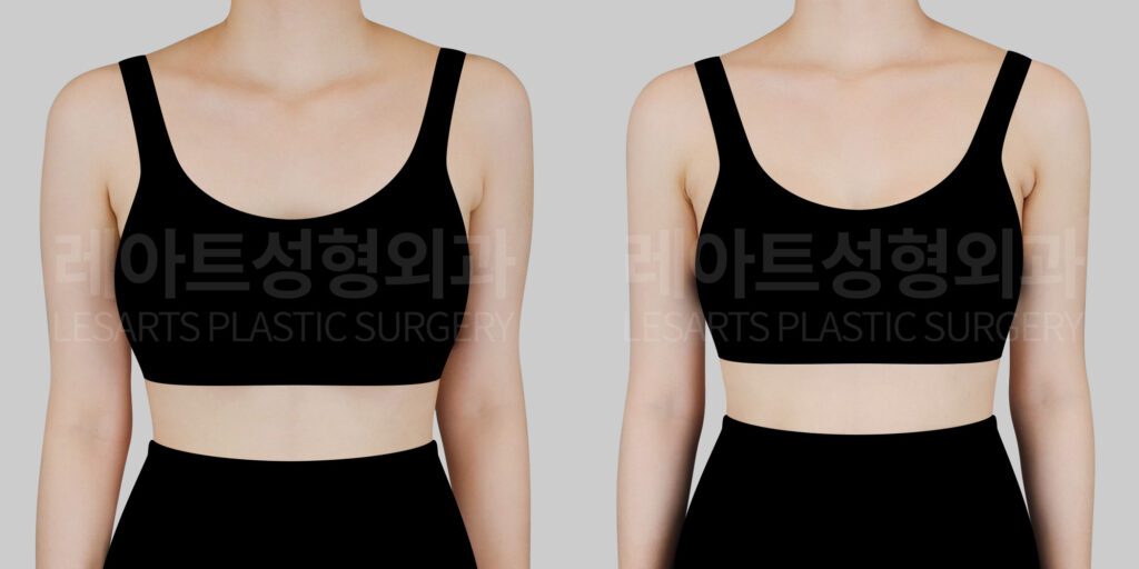 arm liposuction before and after