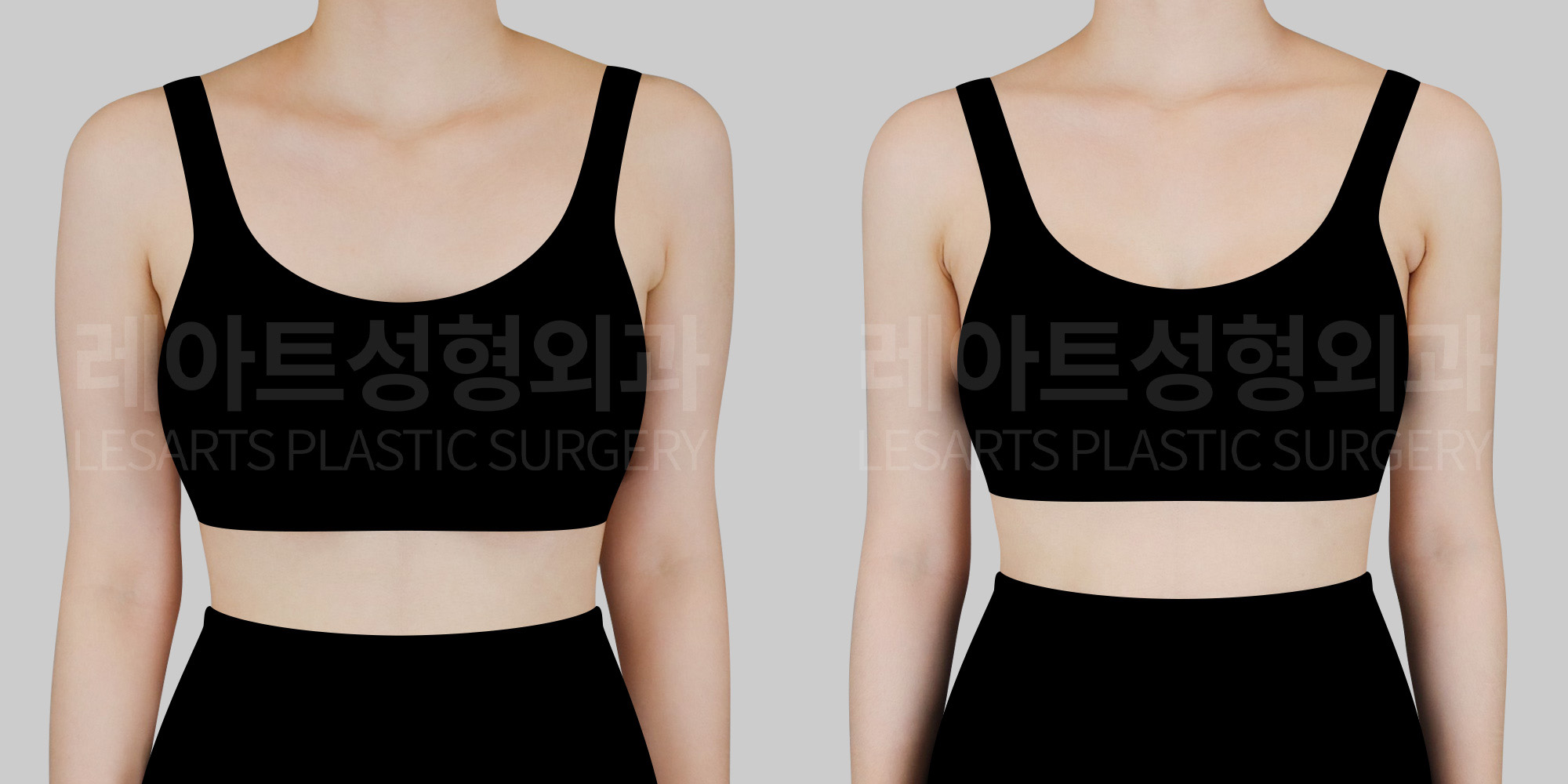 arm liposuction before and after